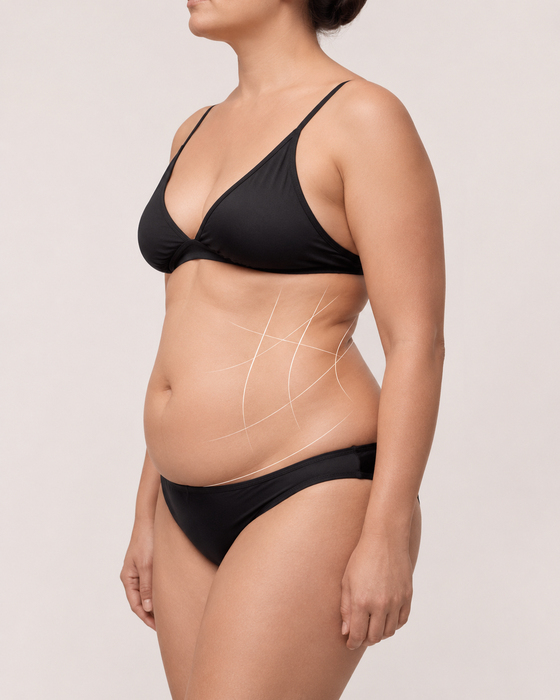 Before liposuction body contouring